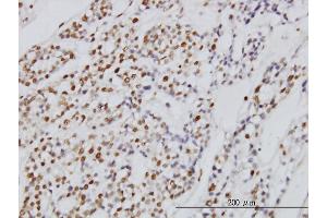 Immunoperoxidase of monoclonal antibody to SYMPK on formalin-fixed paraffin-embedded human ovary, clear cell carcinoma. (Symplekin antibody  (AA 1-533))