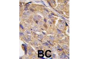 Formalin-fixed and paraffin-embedded human breast carcinoma tissue reacted with EIF4B-, which was peroxidase-conjugated to the secondary antibody, followed by DAB staining. (EIF4B antibody  (AA 400-429))