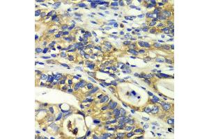 Immunohistochemistry of paraffin-embedded human colon carcinoma using RPH3A antibody at dilution of 1:100 (x40 lens). (RPH3A antibody)