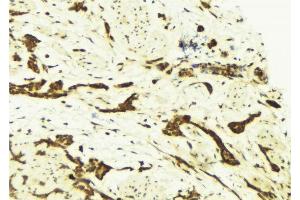 ABIN6269249 at 1/100 staining Human breast cancer tissue by IHC-P. (STAT5A antibody)