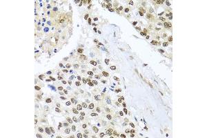 Immunohistochemistry of paraffin-embedded human lung cancer using BNIP3L antibody. (BNIP3L/NIX antibody)