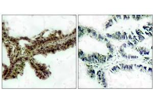 Immunohistochemical analysis of paraffin-embedded human lung carcinoma tissue, using Akt (phospho-Thr308) antibody(E011055). (AKT1 antibody  (pThr308))