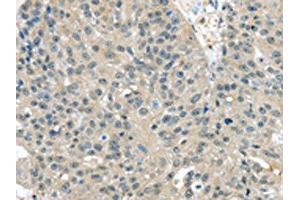 The image on the left is immunohistochemistry of paraffin-embedded Human breast cancer tissue using ABIN7128053(TXNDC17 Antibody) at dilution 1/30, on the right is treated with fusion protein. (TXNDC17 antibody)