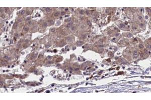 ABIN6273958 at 1/100 staining Human liver cancer tissue by IHC-P. (OR51L1 antibody  (Internal Region))