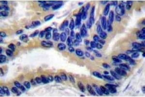 Immunohistochemistry analyzes of Actived-Caspase-3 p17 Antibody in paraffin-embedded human lung carcinoma tissue. (Caspase 3 antibody)