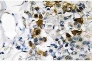 Immunohistochemistry (IHC) analyzes of p-HSP27 antibody in paraffin-embedded human breast carcinoma tissue. (HSP27 antibody  (pSer82))