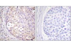 Immunohistochemistry analysis of paraffin-embedded human breast carcinoma tissue, using PKC-pan (Ab-Thr497) Antibody.
