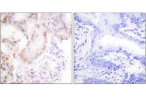 Immunohistochemistry analysis of paraffin-embedded human lung carcinoma tissue, using Cyclin G Antibody. (Cyclin G1 antibody  (AA 161-210))