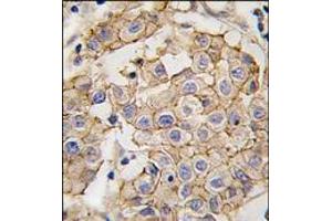 Formalin-fixed and paraffin-embedded human breast carcinoma tissue reacted with HER2 antibody, which was peroxidase-conjugated to the secondary antibody, followed by DAB staining. (ErbB2/Her2 antibody)
