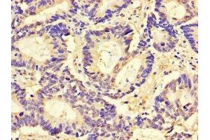 Immunohistochemistry of paraffin-embedded human colon cancer using ABIN7147190 at dilution of 1:100