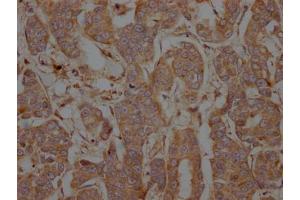 IHC image of ABIN7127784 diluted at 1:100 and staining in paraffin-embedded human breast cancer performed on a Leica BondTM system. (Recombinant PTPN1 antibody)