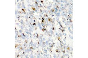 Immunohistochemistry of paraffin-embedded human esophageal cancer using CD68 antibody at dilution of 1:200 (40x lens). (CD68 antibody)