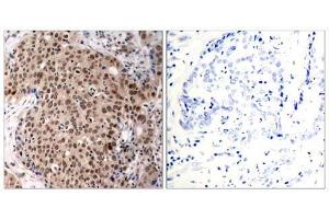 Immunohistochemical analysis of paraffin-embedded human breast carcinoma tissue, using MAPKAPK-2 (Phospho-Thr334) antibody (E011308). (MAPKAP Kinase 2 antibody  (pThr334))