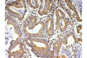 IHC testing of FFPE human rectal cancer tissue with TSPAN12 antibody at 1ug/ml. (TSPAN12 antibody)
