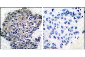 Immunohistochemistry analysis of paraffin-embedded human breast carcinoma, using Filamin A (Phospho-Ser2152) Antibody. (Filamin A antibody  (pSer2152))