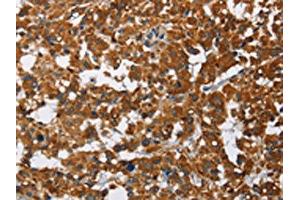The image on the left is immunohistochemistry of paraffin-embedded Human thyroid cancer tissue using ABIN7128790(CAT Antibody) at dilution 1/40, on the right is treated with fusion protein. (Catalase antibody)