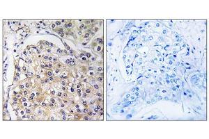 Immunohistochemistry analysis of paraffin-embedded human breast carcinoma tissue using GPR116 antibody. (G Protein-Coupled Receptor 116 antibody  (C-Term))