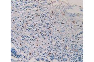 IHC-P analysis of Human Prostate Gland Cancer Tissue, with DAB staining. (TPSAB1 antibody  (AA 161-262))