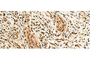 Immunohistochemistry of paraffin-embedded Human esophagus cancer tissue using PPM1G Polyclonal Antibody at dilution of 1:40(x200)