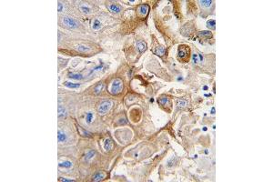 Formalin-fixed and paraffin-embedded human lung carcinoma tissue reacted with CYP2W1 antibody (N-term), which was peroxidase-conjugated to the secondary antibody, followed by DAB staining. (CYP2W1 antibody  (N-Term))