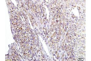 Formalin-fixed and paraffin embedded human cervical carcinoma labeled with Anti APE/Girdin Polyclonal Antibody, Unconjugated (ABIN755587) at 1:200 followed by conjugation to the secondary antibody and DAB staining