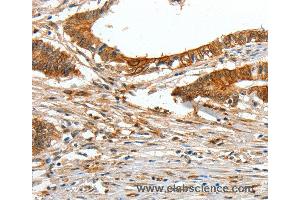 Immunohistochemistry of Human lung cancer using COL1A2 Polyclonal Antibody at dilution of 1:70 (COL1A2 antibody)