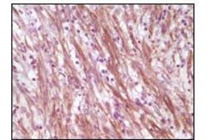 Immunohistochemical analysis of paraffin-embedded human smooth musde sarcoma, showing cytoplasmic localization using Desmin mouse mAb with DAB staining.