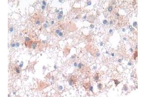 Detection of NCAD in Human Glioma Tissue using Polyclonal Antibody to N-cadherin (NCAD) (N-Cadherin antibody  (AA 685-784))