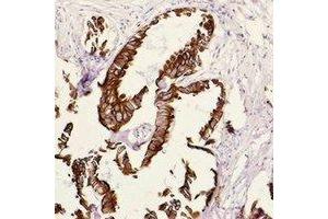 Immunohistochemical analysis of Cytokeratin 18 staining in human breast cancer formalin fixed paraffin embedded tissue section. (Cytokeratin 18 antibody)