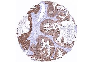 Ovary Mucinous ovarian cancer showing strong villin immunostaining (Recombinant Villin 1 antibody  (AA 600-700))