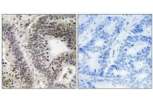 Immunohistochemical analysis of paraffin-embedded human colon carcinoma tissue using WWOX (Phospho-Tyr33) antibody (left)or the same antibody preincubated with blocking peptide (right). (WWOX antibody  (pTyr33))