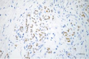 Immunohistochemistry was performed on paraffin-embedded human pancreatic adenocarcinoma using PDX1 antibody (ABIN7799731), 1:200). (Recombinant PDX1 antibody)