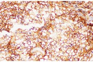 Immunohistochemistry of paraffin-embedded Human kidney cancer using FOLH1 Polycloanl Antibody at dilution of 1:200 (PSMA antibody)