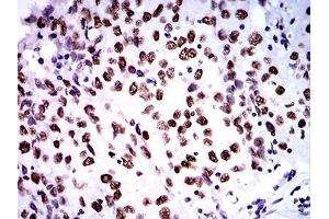 Immunohistochemical analysis of paraffin-embedded ovarian cancer tissues using ZFP91 mouse mAb with DAB staining. (ZFP91 antibody  (AA 162-304))