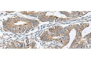 Immunohistochemistry of paraffin-embedded Human colorectal cancer tissue using DPY19L3 Polyclonal Antibody at dilution of 1:120(x200) (DPY19L3 antibody)