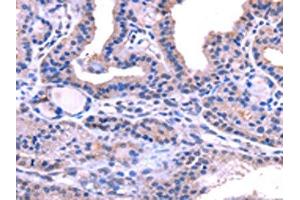 The image on the left is immunohistochemistry of paraffin-embedded Human thyroid cancer tissue using ABIN7131472(TRIM14 Antibody) at dilution 1/40, on the right is treated with fusion protein.