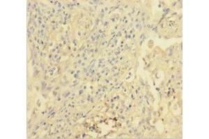 Immunohistochemistry of paraffin-embedded human lung cancer using ABIN7175384 at dilution of 1:100 (VEGFR2/CD309 antibody  (AA 20-764))
