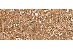Immunohistochemistry of paraffin-embedded Human liver cancer tissue using CALML6 Polyclonal Antibody at dilution of 1:55(x200) (CALML6 antibody)