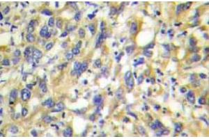 Immunohistochemistry  (IHC) analyzes of MKP-4 antibody in paraffin-embedded human liver carcinoma tissue. (DUSP9 antibody)