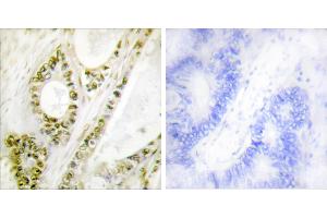 Immunohistochemistry analysis of paraffin-embedded human colon carcinoma tissue using IRF-3 (Phospho-Ser385) antibody. (IRF3 antibody  (pSer385))