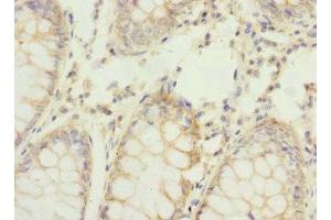 Immunohistochemistry of paraffin-embedded human colon cancer using ABIN7159199 at dilution of 1:100 (REC8 antibody  (AA 1-270))