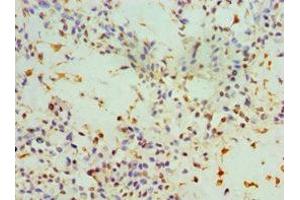 Immunohistochemistry of paraffin-embedded human breast cancer using ABIN7143947 at dilution of 1:100 (SNCA antibody  (AA 61-140))