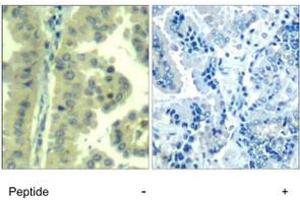 Imunohistochemical analysis of paraffin-embedded human lung carcinoma tissue, using EIF4G1 polyclonal antibody . (EIF4G1 antibody  (Ser1232))