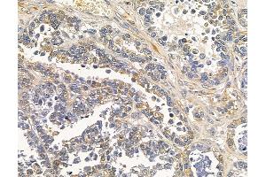 ABIN7095140 and ABIN7099196 at 1/100 staining human ovarian cancer by IHC-P.