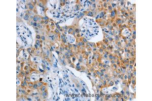 Immunohistochemistry of Human thyroid cancer using ASL Polyclonal Antibody at dilution of 1:35