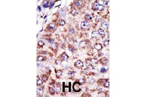 Formalin-fixed and paraffin-embedded human hepatocellular carcinoma tissue reacted with FDFT1 polyclonal antibody  , which was peroxidase-conjugated to the secondary antibody, followed by DAB staining . (FDFT1 antibody  (N-Term))