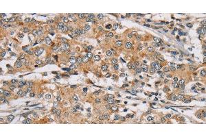 Immunohistochemistry of paraffin-embedded Human liver cancer tissue using RAB24 Polyclonal Antibody at dilution 1:45 (RAB24 antibody)