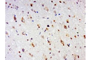 Paraformaldehyde-fixed, paraffin embedded human glioma tissue, Antigen retrieval by boiling in sodium citrate buffer(pH6) for 15min, Block endogenous peroxidase by 3% hydrogen peroxide for 30 minutes, Blocking buffer (normal goat serum) at 37°C for 20min, Antibody incubation with GPCR EX33 Polyclonal Antibody, Unconjugated  at 1:500 overnight at 4°C, followed by a conjugated secondary and DAB staining (GPR84 antibody  (AA 21-120))