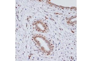 Immunohistochemistry of paraffin-embedded human breast cancer using TriMethyl-Histone H3-K27 antibody (ABIN3023268, ABIN3023269, ABIN3023270, ABIN1513002 and ABIN6219521) at dilution of 1:100 (40x lens). (Histone 3 antibody  (H3K27me))