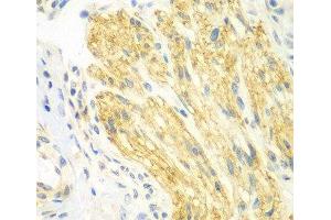 Immunohistochemistry of paraffin-embedded Human gastric cancer using PTK6 Polyclonal Antibody at dilution of 1:100 (40x lens).